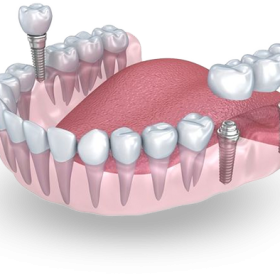implante-dentario-simioni